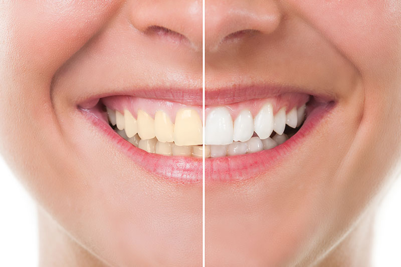 Teeth Whitening in Union City